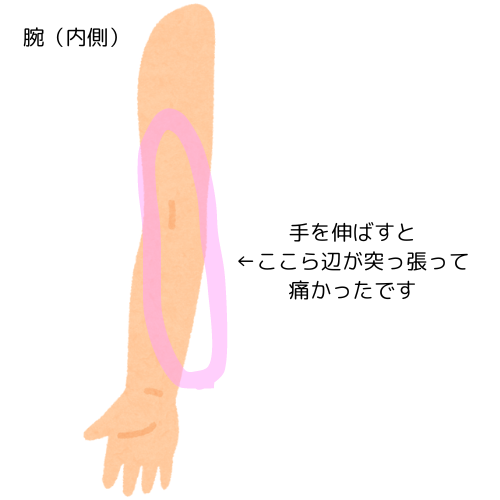 副乳がん手術とリンパ郭清のリハビリ経過