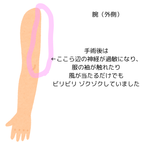副乳がん手術とリンパ郭清のリハビリ経過